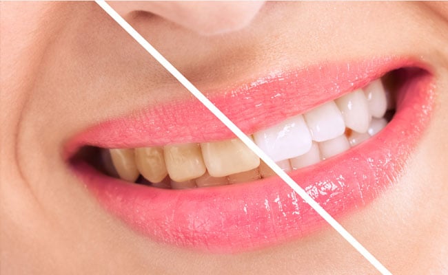 दाँतो की गंदगी को बाहर निकालने के लिए फॉलो करें ये आसान से टिप्स, चमकने लगेंगे दांत