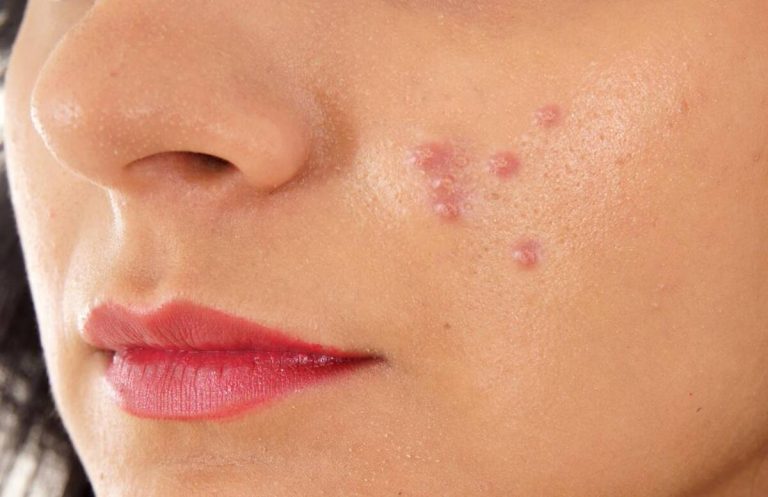 Beauty tips pimples को कम करने के लिए ध्यान रखें इन बातों का