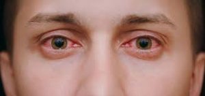 Eye Flu के लक्षण 