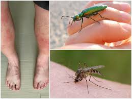 अमेरिका में कीड़े के काटने से फैल रही ये खतरनाक बीमारी, क्या भारत में भी है खतरा?